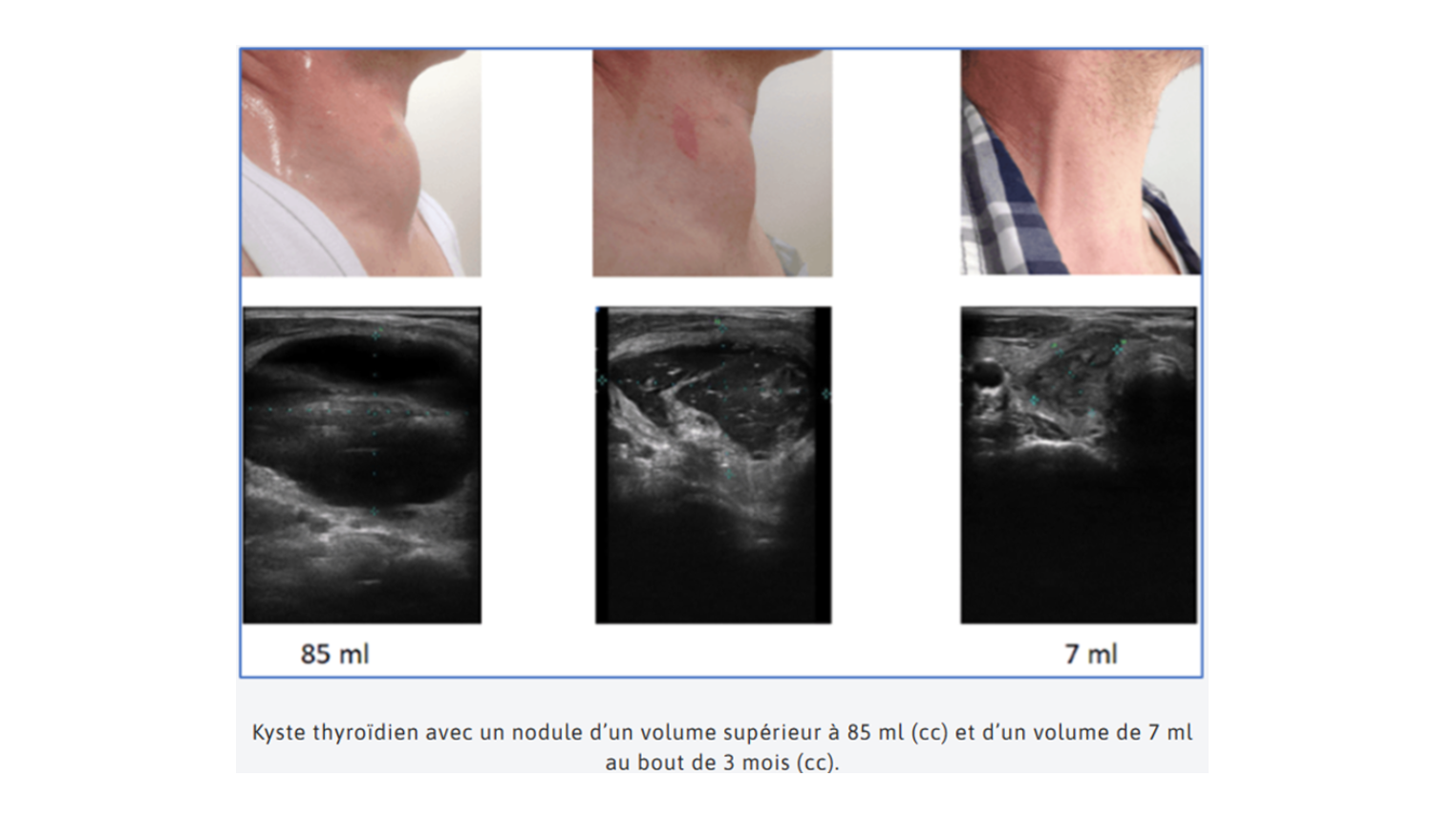 Evolution-Thermo-ablation.png Evolution-Thermo-ablation.png